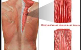 Продуло спину болит что делать