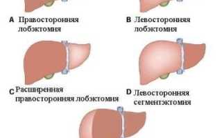 После операции на печени болит спина