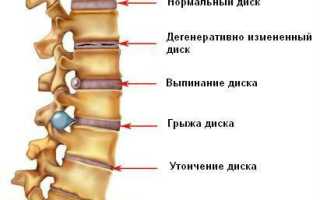 Печет спина болит плечо