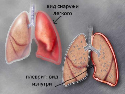 Причина болей в правом боку отдающая в спину