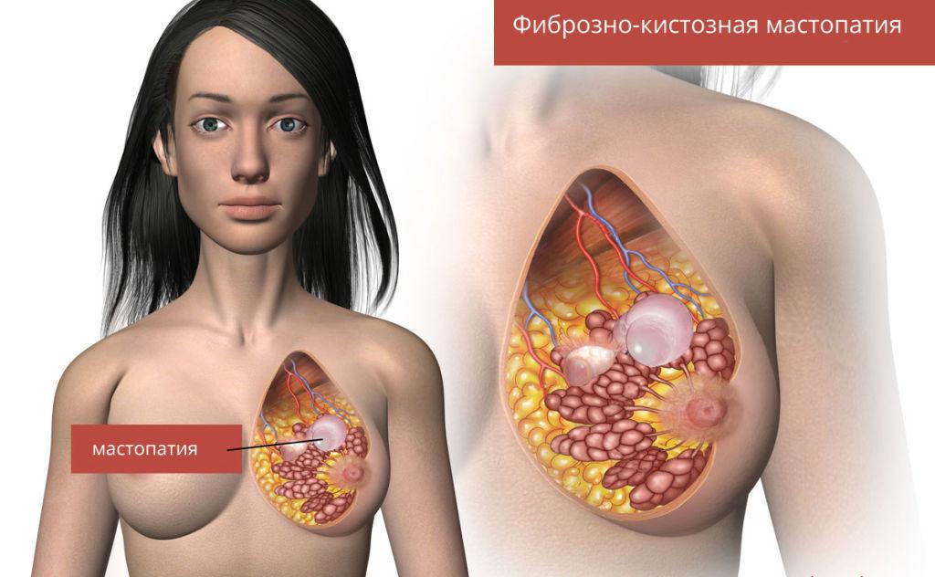 Задержка месячных и болит грудь