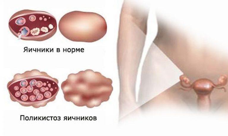 Задержка месячных и болит грудь