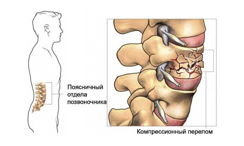 Компрессионный перелом позвоночника