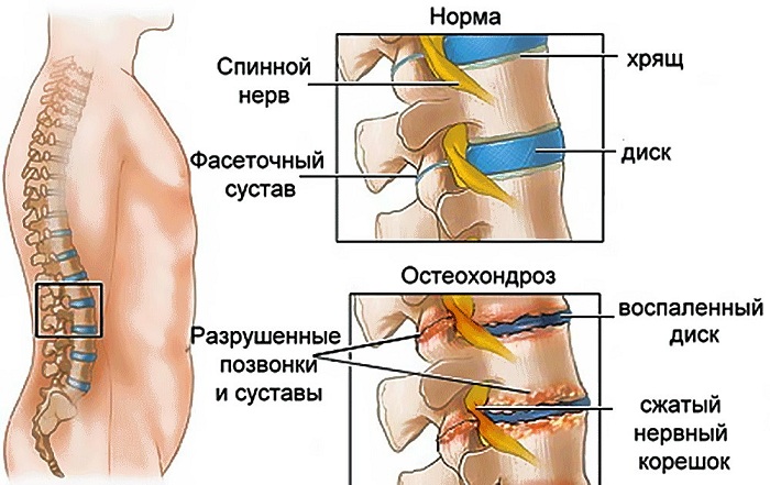 Остеохондроз 