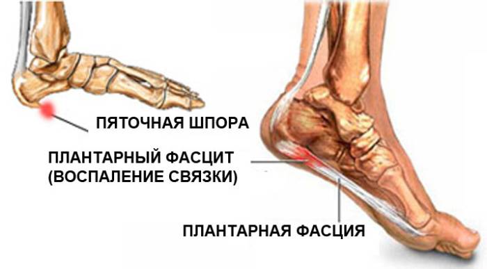 Плантарный фасциит