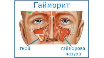 Если спина болит может быть небольшая температура