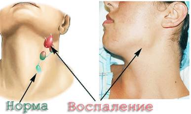 Если спина болит может быть небольшая температура