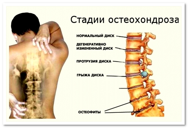 Стадии остеохондроза