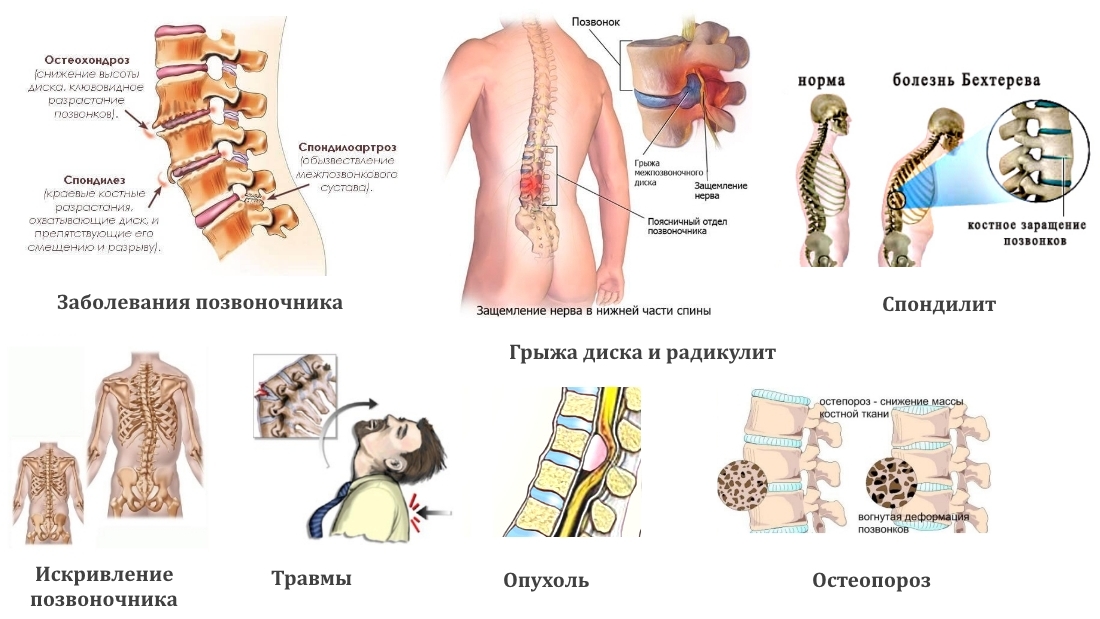 Заболевания позвоночника