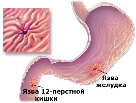 Язва желудка