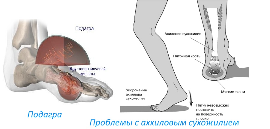 Заболевания пяток