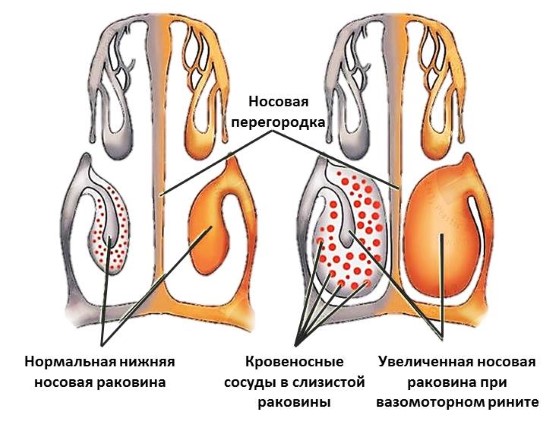 Нос болит и голова аллергия
