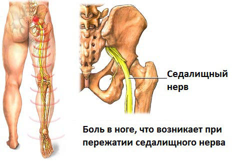 Ишиас