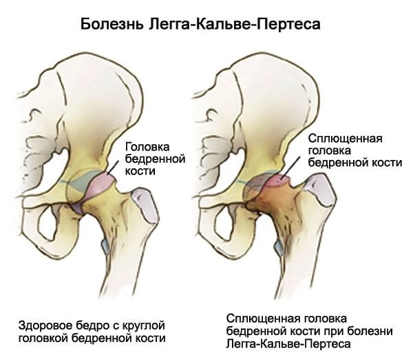Что убрать из рациона если болит спина и суставы