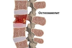 Если спина болит может быть небольшая температура