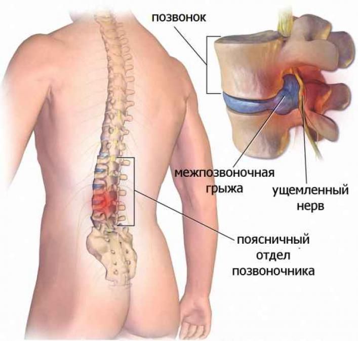 Болит нижний бок спины
