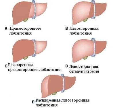 Резекция печени